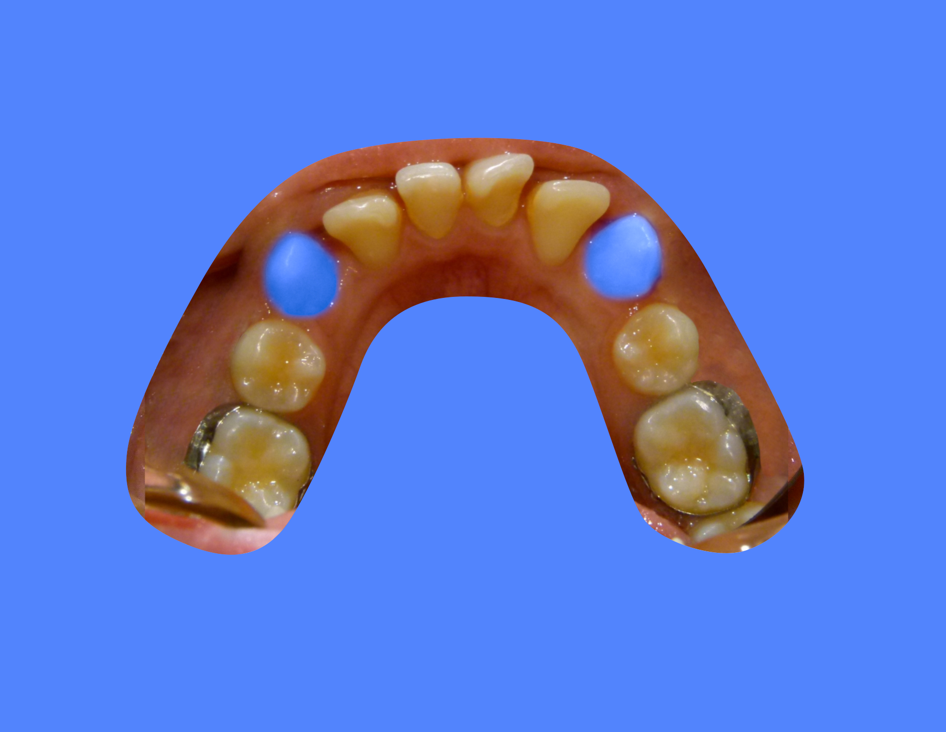 After image showing patient with aligned teeth